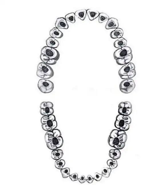 全口牙齿开髓点