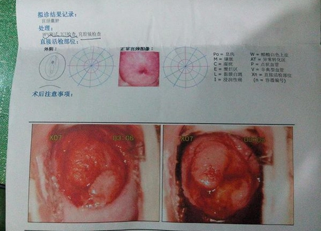 hpv还是tct宫颈癌筛查用谁靠谱