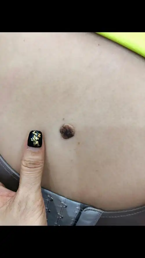 15毫米的大肉痣祛除