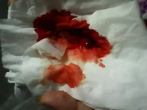 突然吐血是怎么回事?