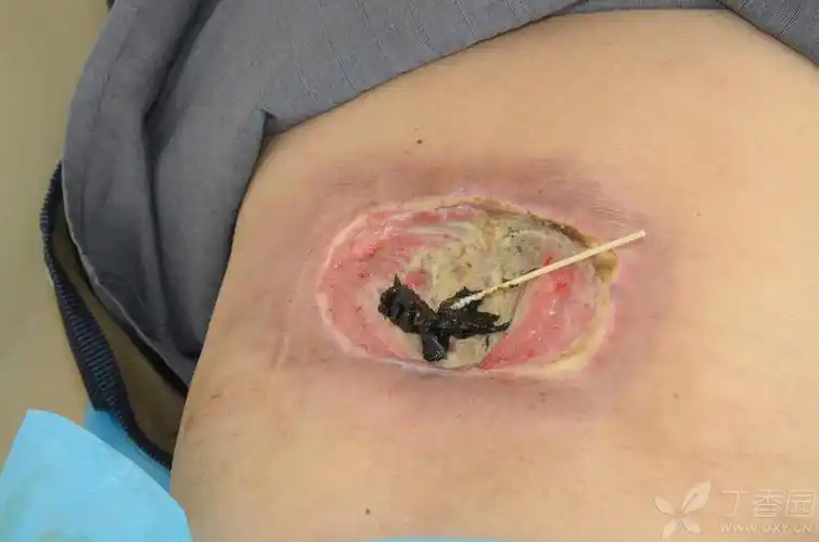 糖尿病患者背部严重溃烂,就诊多家医院治疗无效,而转入我院救治 [病例