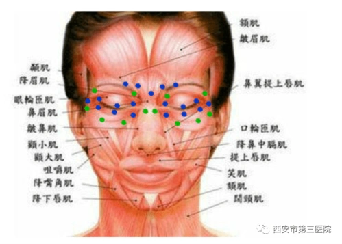 【学科发展】市三院神经内科开设"肉毒素门诊",一针搞定!