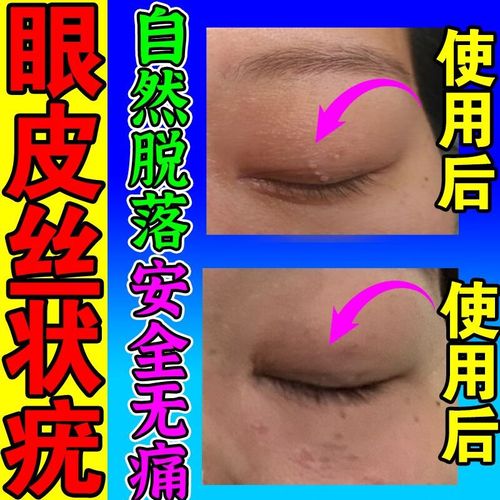 小肉粒去除膏扁平疣疣瘊专用膏 丝状疣眼皮刺猴瘊子肉粒疙瘩去皮 买5