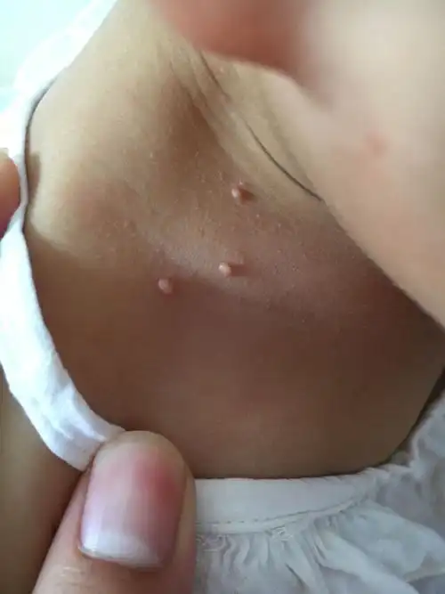 孩子身上长了一些和水泡差不多的东西,去医院医生说是扁平疣.