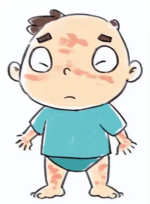 过敏性皮炎的图片大全(荨麻疹奇痒难忍) - 赤虎壹号