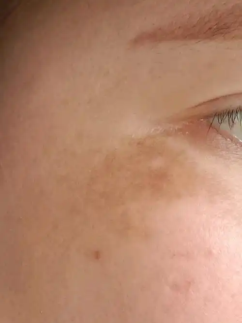 脸两侧眼角下方有一点斑……话说皮秒效果应该比普通激_圈子-新氧美容