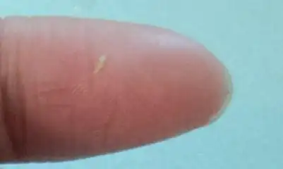 褃面挤出来的白色东西如果是很长很细的那种,而且是条型的,就是粉刺栓