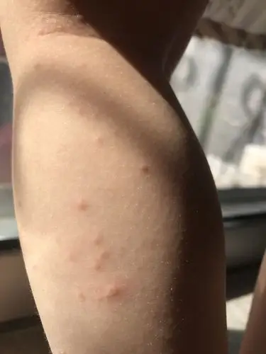 两岁孩子腿上长小疙瘩,一周了,越来越多,痒痒不发烧,请问这是什么?