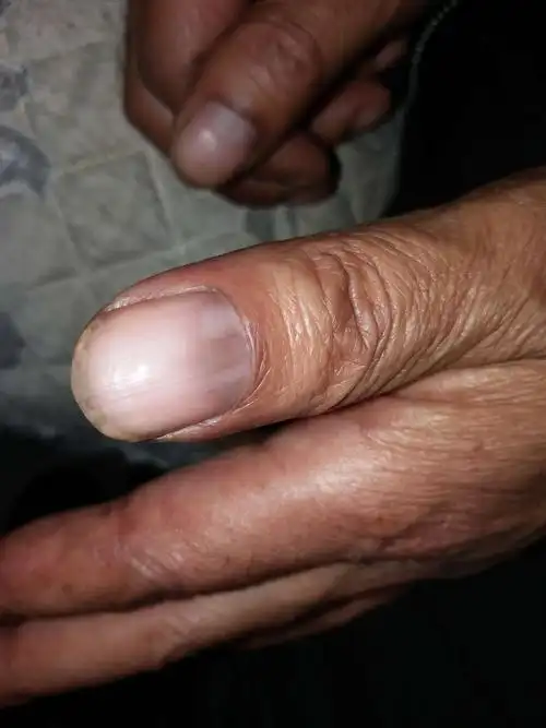 手指半月板地方发紫