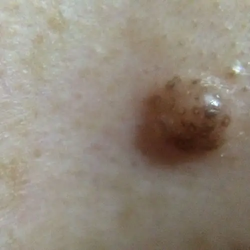 麻烦医生进来看看老婆鼻翼上长了颗不知名的肉包