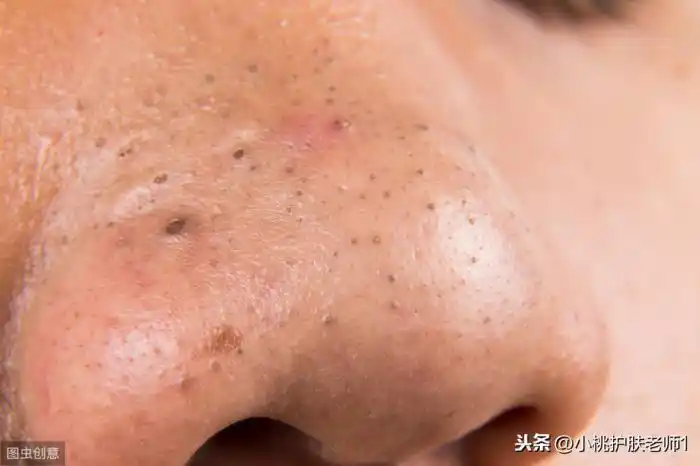 黑头导出液怎么用(黑头导出液有没有副作用)_可可情感网