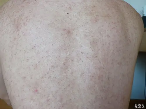 皮肤病请教糠秕孢子菌毛周角化吗