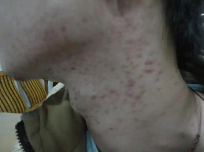 毛囊炎  治疗方法