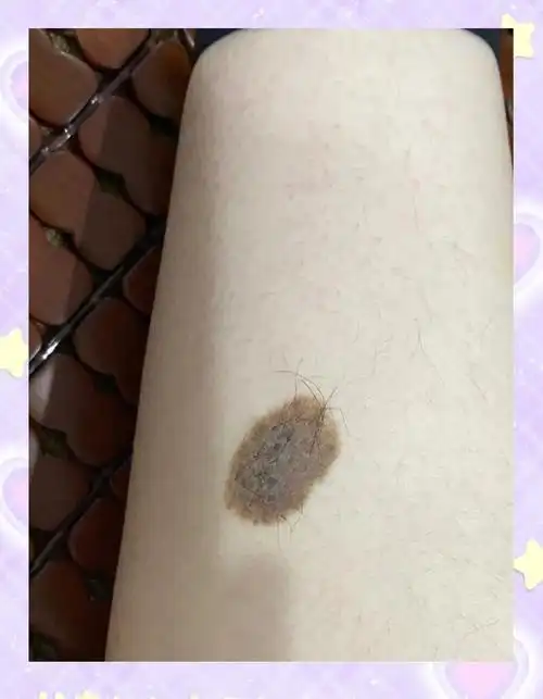 你真的了解身上的黑色胎记吗?