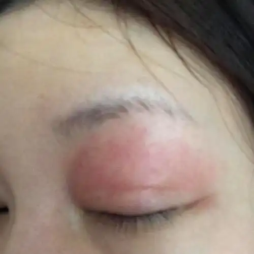 我的天呐 眼睛肿成这样该怎么办