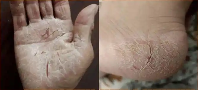 皲裂流血,看着就疼,我只花10块钱,摆脱了困扰父母十年的烦恼_皮肤_庐