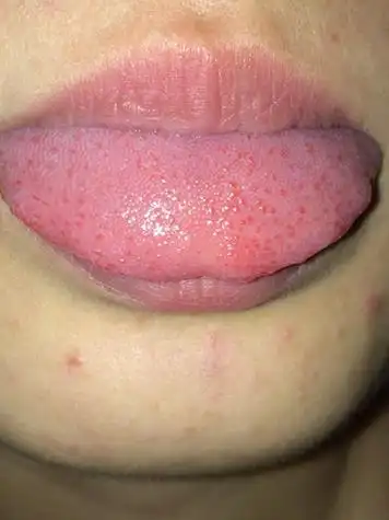 白色念珠菌病和毛状白斑是比较常见的hiv感染初期的舌头症状,它与消化