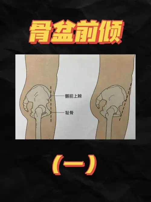 什么是骨盆前倾8915在身体的侧面位中,髂前上棘与耻骨不垂直对齐