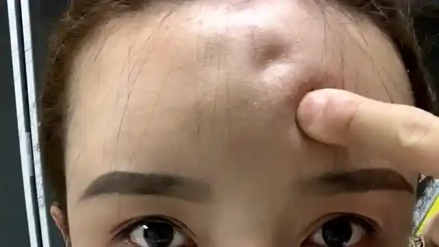 整容后遗症多奇葩,额头玻尿酸打多了以后,一按一个坑隔着屏幕我都害怕