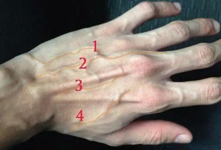 手上的青筋特别明显是不是因为生病了医生终于说出了实话