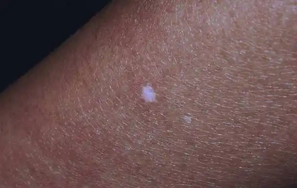 医生,我身上的白斑是不是白癜风?