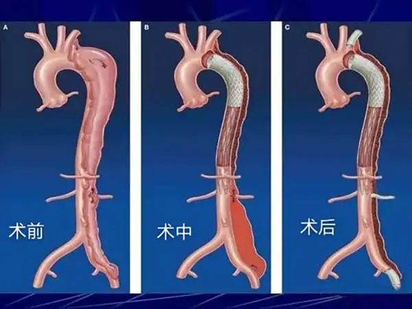 不可忽视的体内"定时炸弹"——主动脉夹层