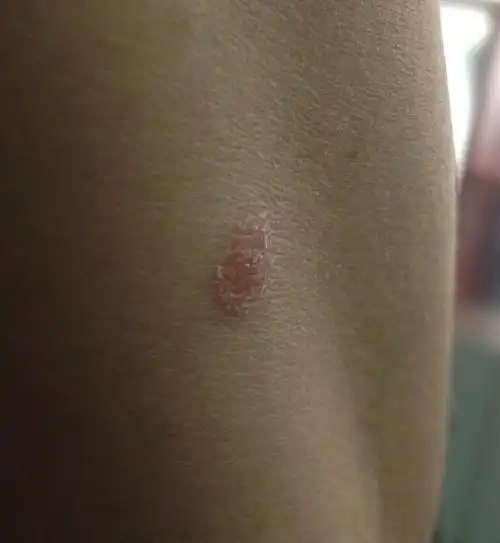 身上长的小红疙瘩