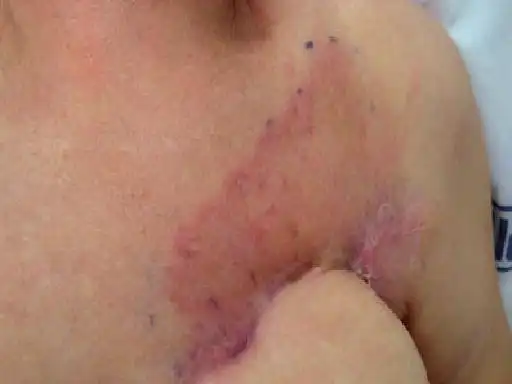 dermatol 上报告了 3 例以环形红斑为局部复发性病变首发表现的乳腺癌