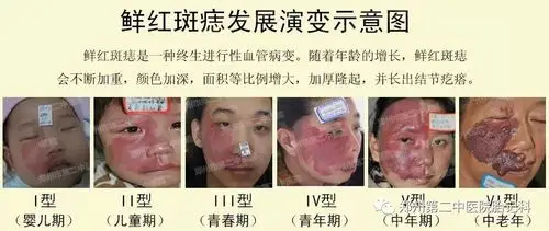 你知道你的胎记是哪种吗?一起看图识胎记