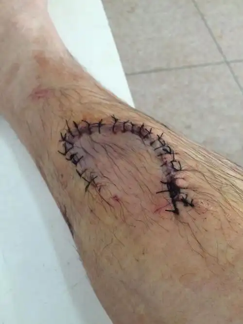 小腿刀切了缝了25针怎么好的快