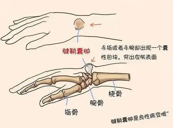 不手术,外洗(针刺)消腱鞘炎/腱鞘囊肿于无形