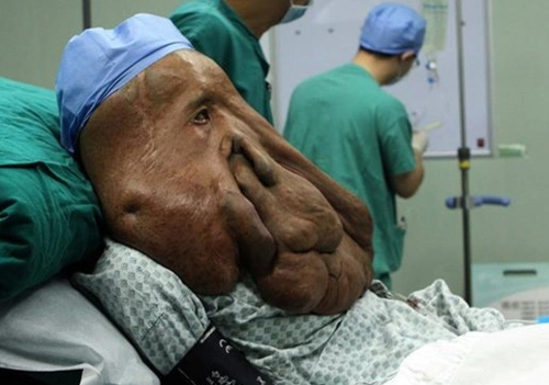 手臂皮下脂肪瘤图片