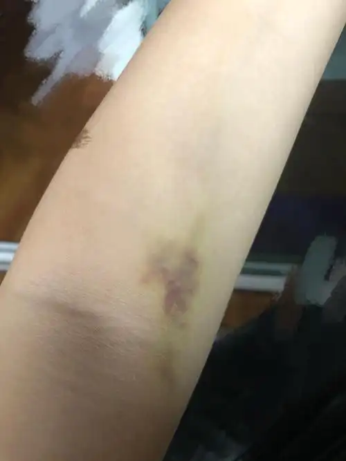 抽完血以后出现淤青块 有图