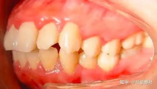 经常被误解看起来很凶像是在生气;凸嘴类型分为唇性,牙性,骨性或混合