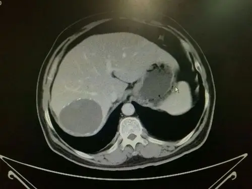 每周诊疗笔记之肝包虫病外科治疗