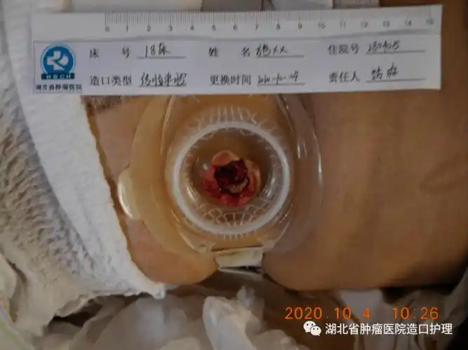 如何正确选择合适的造口袋型号