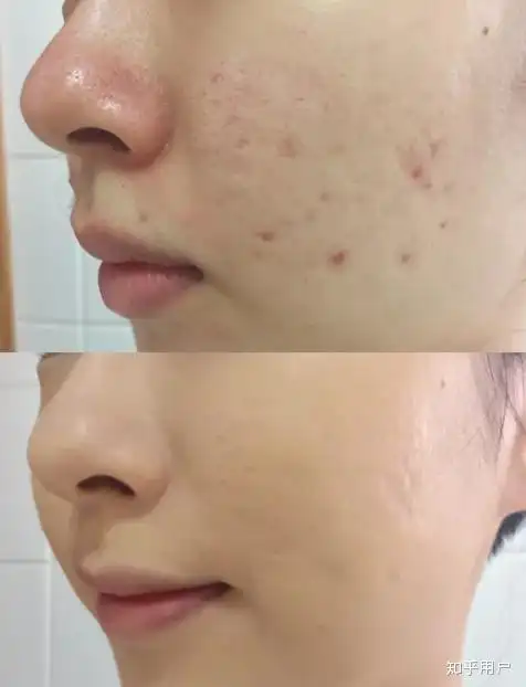 怎样可以快速有效的祛痘和黑头痘印?