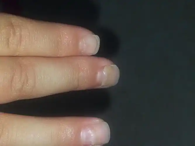 请教大虾,三岁多的小孩儿手指甲盖脱落是怎么回事,拍了几张图,大家