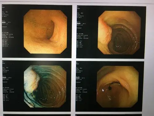 首页 资讯 真实案例:日本体检发现早期重大疾病关于胃镜的一些感受和