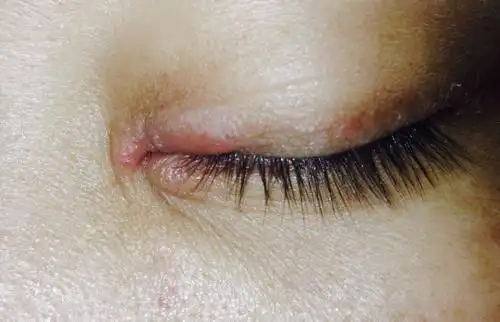 之前脸上有脂溢性皮炎 去大连皮肤科诊所开了面膜 回来贴 眼皮也好了