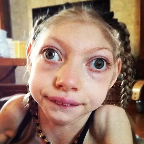 美14岁小头症患者仅重21斤 常被误认为婴儿_新闻频道_中国青年网