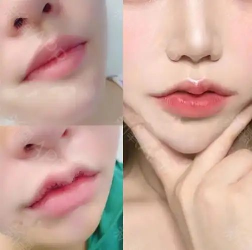 m唇手术好不好_效果图_一身勤俭m唇手术术后第388天_新氧美容整形