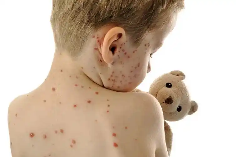水痘(varicella,chickenpox)是由水痘-带状疱疹病毒初次感染引起的
