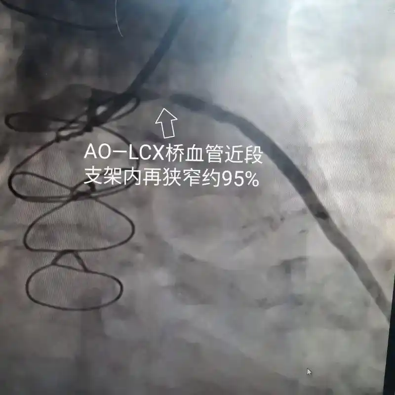 患者多年前因为冠脉病变太严重,当时 - 抖音