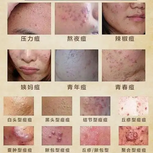 大量粉刺及炎性丘疹,间有脓疱结节囊肿,皮疹红肿疼痛 右侧面颊痘痘