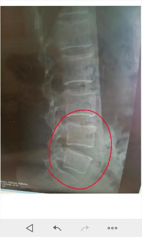 腰椎骨有点增生.是不是