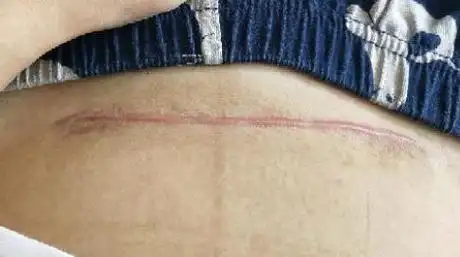 剖腹产刀口42天恢复图(剖腹产刀口的3种类型)