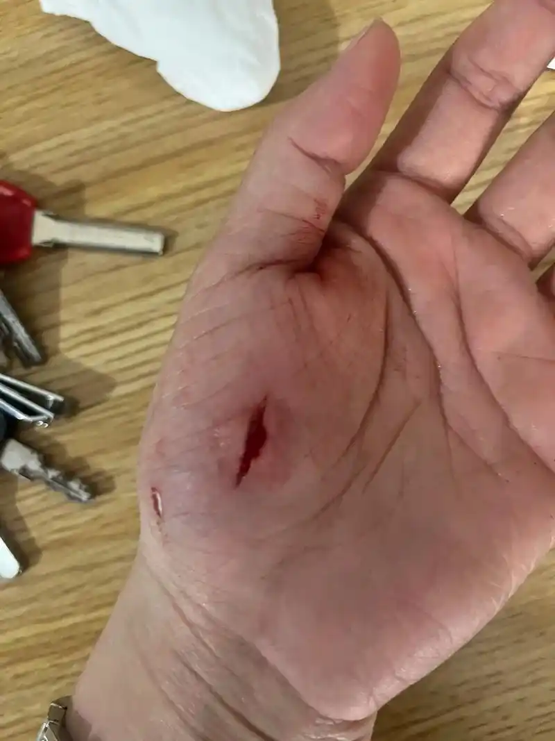 一不小心手受伤了,看着流血不止的那一刻我没有矫情,人生有太多 - 抖