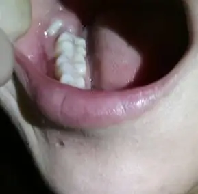 我的智齿是不是长歪了,能不能拔除?