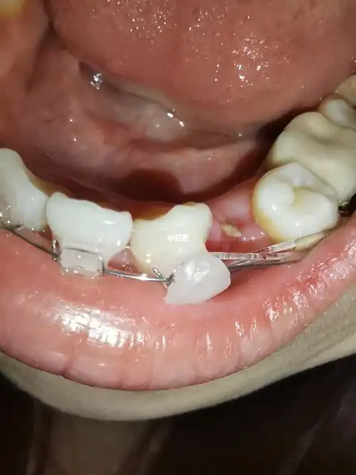 有拔牙后牙窝长出这个东西的吗